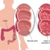 Early Cancer Detection Saves Lives: the 5 Major Symptoms of Colon Cancer