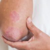Suffering from Psoriasis? Try Honey & Turmeric Remedy