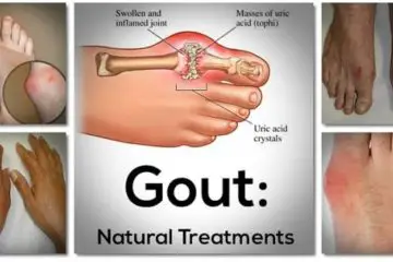 Relieve Gout with this Amazing All-Natural Treatment