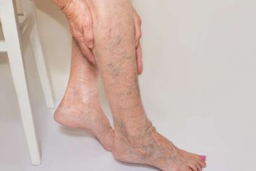 Chronic Venous Insufficiency Triggers Leg Ache; 5 Natural Ways to Relieve the Symptoms