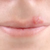 The Best Natural Ways to Alleviate Herpes Symptoms