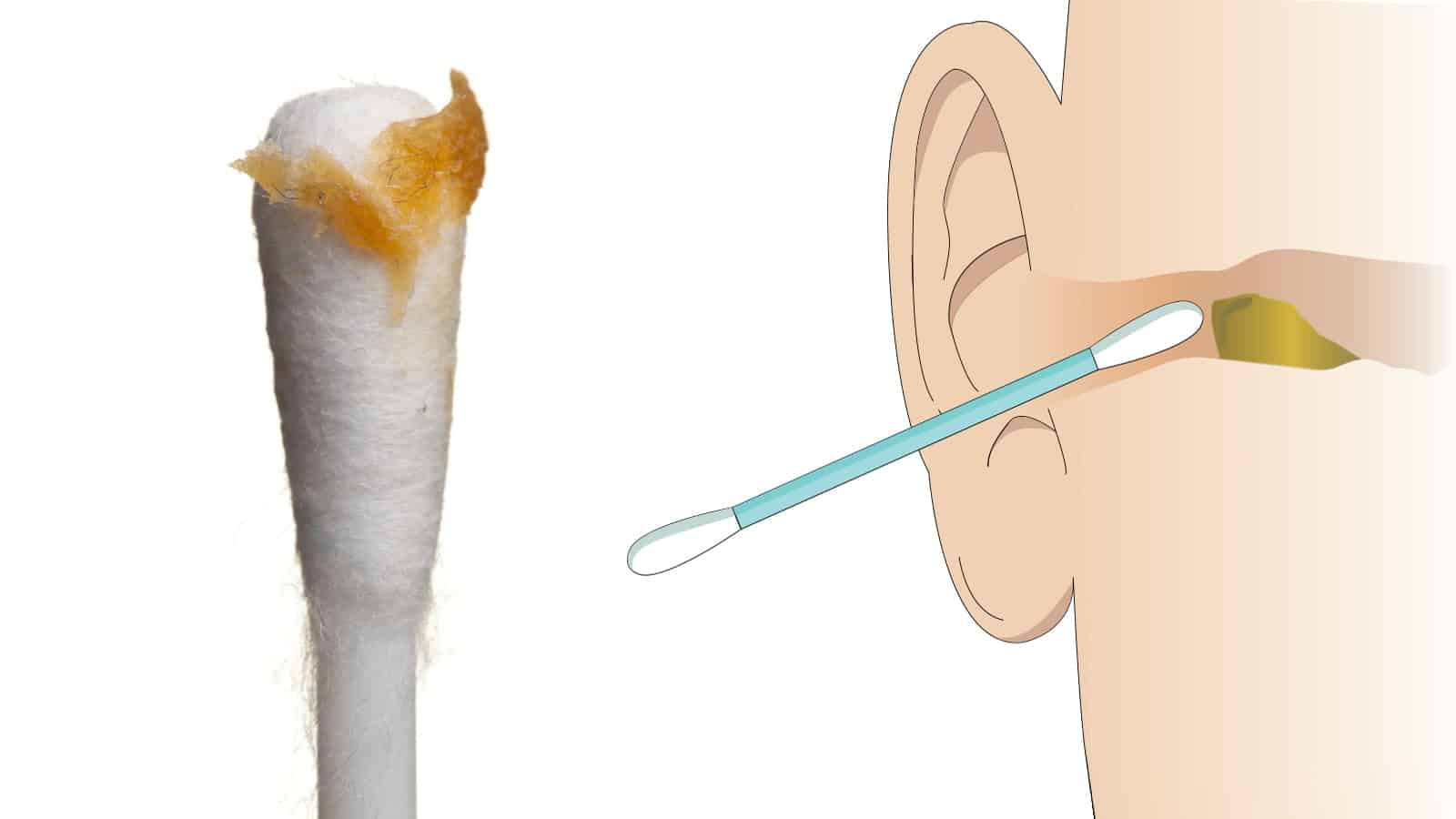 Ear Specialist Warn Us 5 Reasons Why We Need to Stop Using Cotton Buds