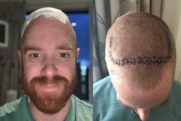 Adelaide Patient Gets a ‘Brain Pacemaker’ to Help with Early Onset Parkinson’s