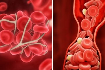 10 Useful Tips to Help Avert Blood Clots & Preserve Your Health