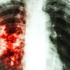 Home Remedies to Help with Tuberculosis Symptoms
