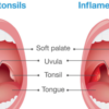 Alleviate Tonsillitis with these 5 Simple & Effective Natural Remedies