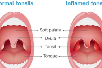 Alleviate Tonsillitis with these 5 Simple & Effective Natural Remedies