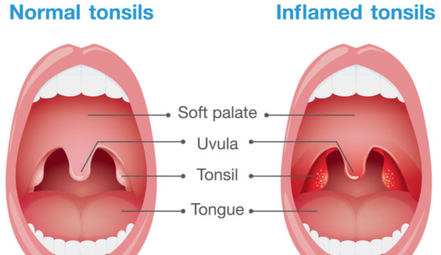Alleviate Tonsillitis with these 5 Simple & Effective Natural Remedies