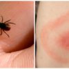 Oh, No: Illness Found that Is Transmitted by a Tick Species