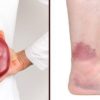 Don’t Ignore these 20 Symptoms of Chronic Kidney Disease