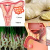 Could Ginger Be the Answer to Ovarian & Prostate Cancer?