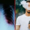 CDC Warns against Vaping after Spike in Lung Disease