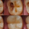 Scientists Work on Developing a Hydrogel for Tooth Enamel Regeneration