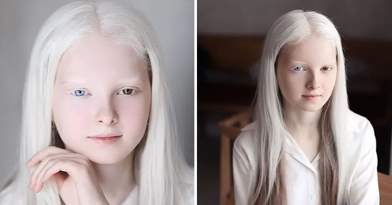 Ethereal Portraits Highlight The Unique Beauty Of A Girl With Albinism And Heterochromia