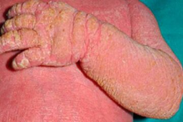 Baby Suffering from Incurable & Rare Skin Disorder Gets Life-Changing Treatment