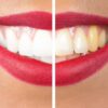 Say Goodbye to Yellow Teeth with these 5 Natural Whiteners
