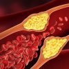 Top 10 Spices & Herbs to Unclog Your Arteries & Prevent a Heart Attack