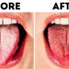 10 Natural Ways to Get Rid of White Tongue