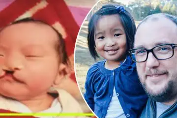 Man Born with a Cleft Lip Adopts a Baby Girl with the Same Condition