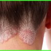 5 Helpful Home Remedies to Relieve Scalp Ringworm