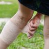 5 Home Remedies to Treat Phlebitis (Vein Inflammation) Naturally