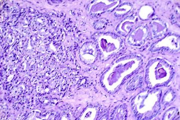 Magnets Made by Soil Bacteria Hopeful for Treatment of Breast & Prostate Cancer