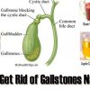 Natural & Effective: The Best Home Remedies for Gallstones