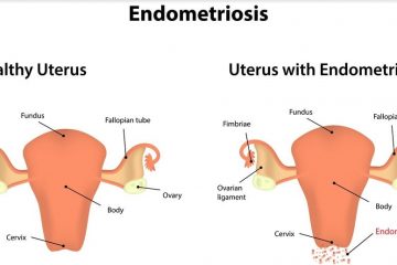 Alleviate the Symptoms of Endometriosis with these Powerful Home Remedies