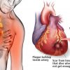 80% of Heart Attacks Could Be Avoided by Doing These 5 Easy Things