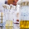 Sediment in Your Urine: Here Is What It Really Means