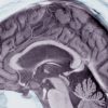 Safety Data for Alzheimer’s Drug Aduhelm Shows: 40 % of the Participants in the Study Have Brain Swelling or Bleeding