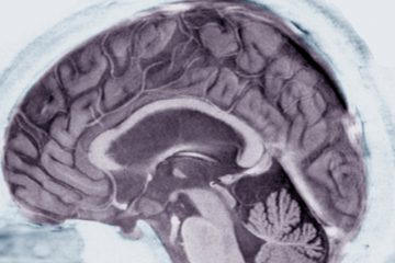 Safety Data for Alzheimer’s Drug Aduhelm Shows: 40 % of the Participants in the Study Have Brain Swelling or Bleeding