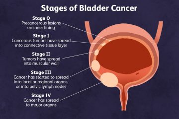 Bladder Cancer Can Be Diagnosed Early: Here Are the Major Symptoms