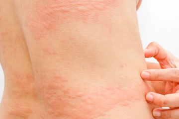 16 Signs of Histamine Intolerance & The Reasons for It