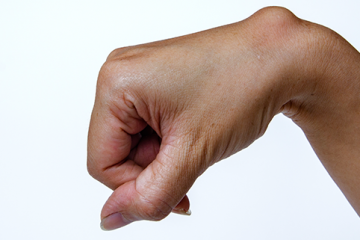 Is a Bump on Your Wrist a Cause for Concern?-See What You Should Do