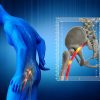 The Top 8 Natural Treatments for Sciatic Pain