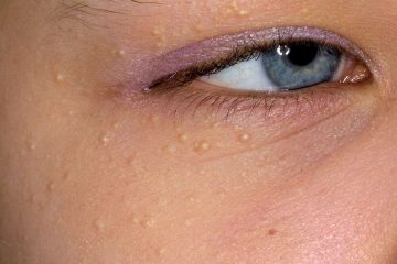 If You Have These Tiny White Bumps on Your Face, Don’t Try to Remove Them