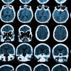 2 Drugs Identified: They Could Halt the Progression of All Neurodegenerative Diseases