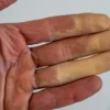 When Cold Makes Your Fingers and Toes Turn White or Blue: Understanding a Rare Vascular Response