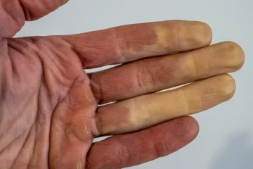 When Cold Makes Your Fingers and Toes Turn White or Blue: Understanding a Rare Vascular Response
