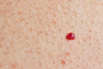 Why You Have Red Dots on Your Skin: Causes, Meanings, and Natural Relief
