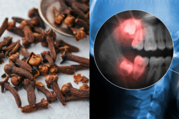 How To Naturally Relieve Toothache With Cloves