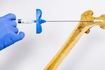 Now hidrogel injection literary strengths bones increasing density by 5x
