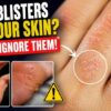 If These Tiny Blisters Keep Showing Up, Here’s What They May Mean
