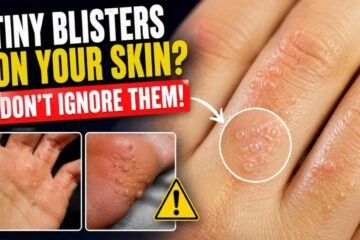 If These Tiny Blisters Keep Showing Up, Here’s What They May Mean