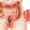Bleeding After a Bowel Movement? It May Not Always Be “Just Hemorrhoids”