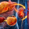 Your Fatty Liver May Be Affecting More Than Your Liver—Your Kidneys Could Be Paying the Price