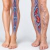 Varicose Veins After 40? This Essential Vitamin May Be Missing From Your Diet
