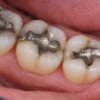 Europe Restricted These Mercury Fillings. Why Are They Still Used in America?