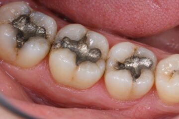 Europe Restricted These Mercury Fillings. Why Are They Still Used in America?